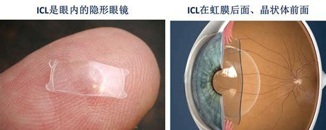 icl晶体植入手术可以维持多少年(icl晶体植入近视手术的利与弊)