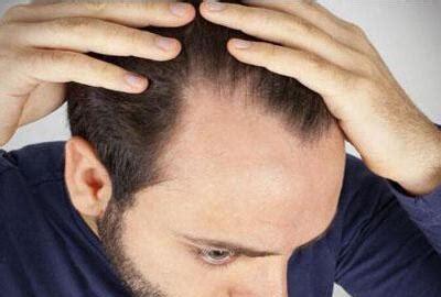 正常人每次洗头掉多少根头发属于正常现象(每天掉100根头发是正常吗)